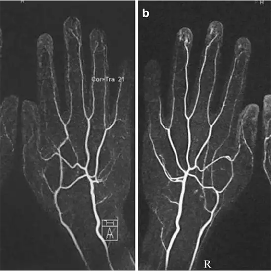 MR Right Hand Angiography